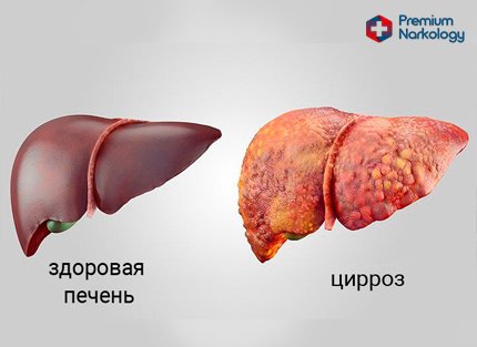 Рисунок здоровой и больной печени